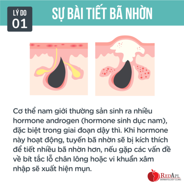LÍ DO GÂY MỤN Ở NAM GIỚI KHÔNG PHẢI AI CŨNG BIẾT